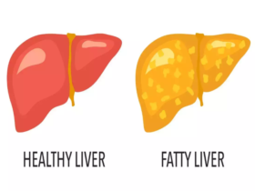 Best Guides For Fatty Liver Treatment And Its Causes